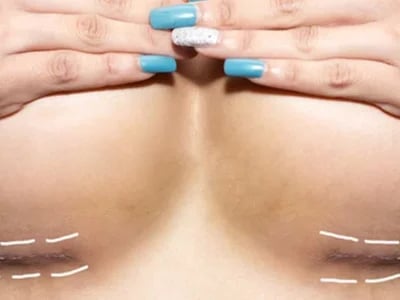 Brustvergrößerung mit Eigenfett: Der minimalinvasive Eingriff für mehr Natürlichkeit