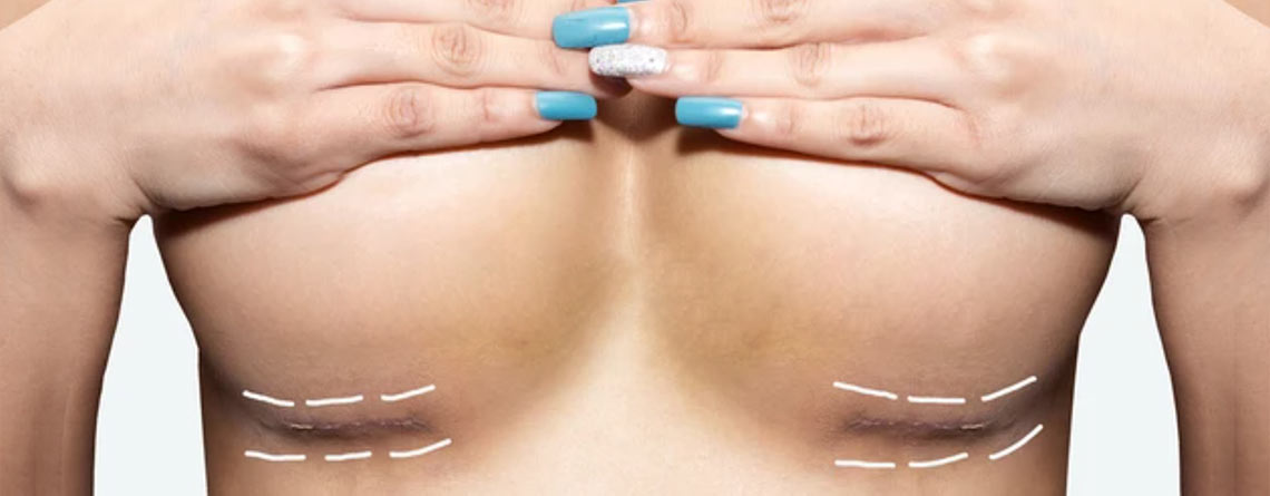 Brustvergrößerung mit Eigenfett: Der minimalinvasive Eingriff für mehr Natürlichkeit