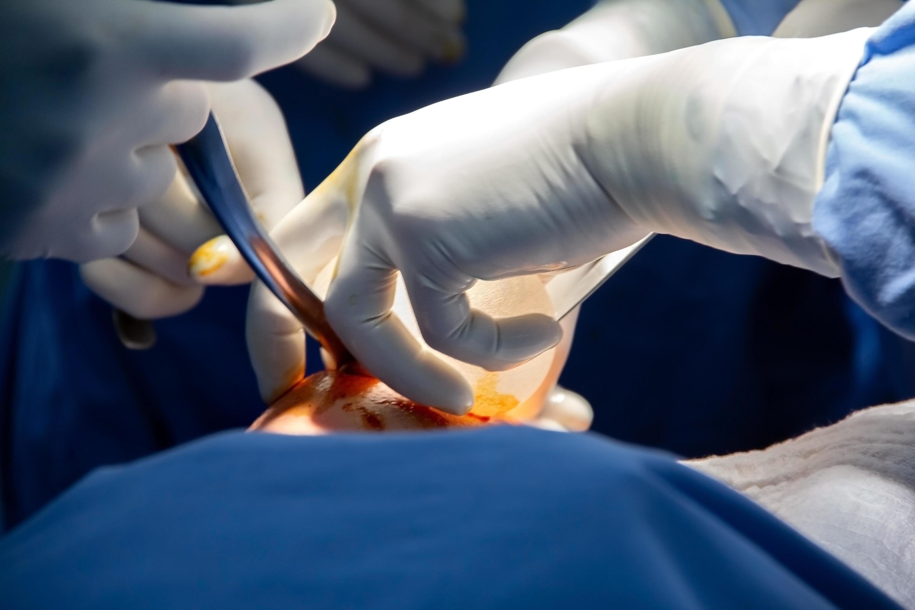 Brustverkleinerung und Ihre Vorteile: Bochum als Zentrum für Ästhetische Chirurgie